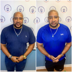 before & after SMP