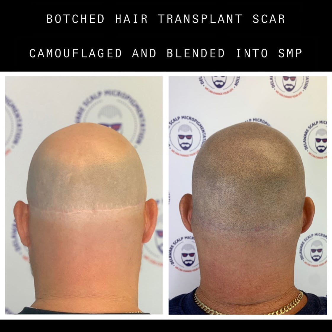 Transplant Scar Back of head