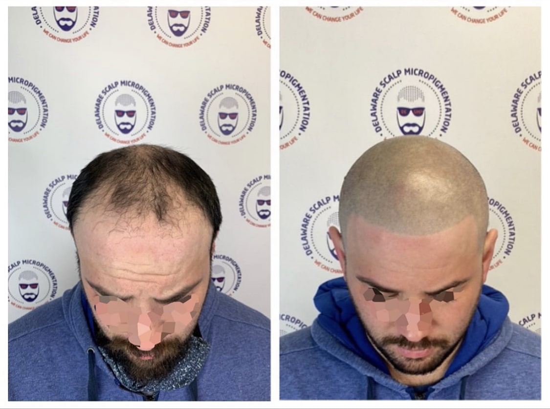Game Changer Before and after scalp micropigmentation